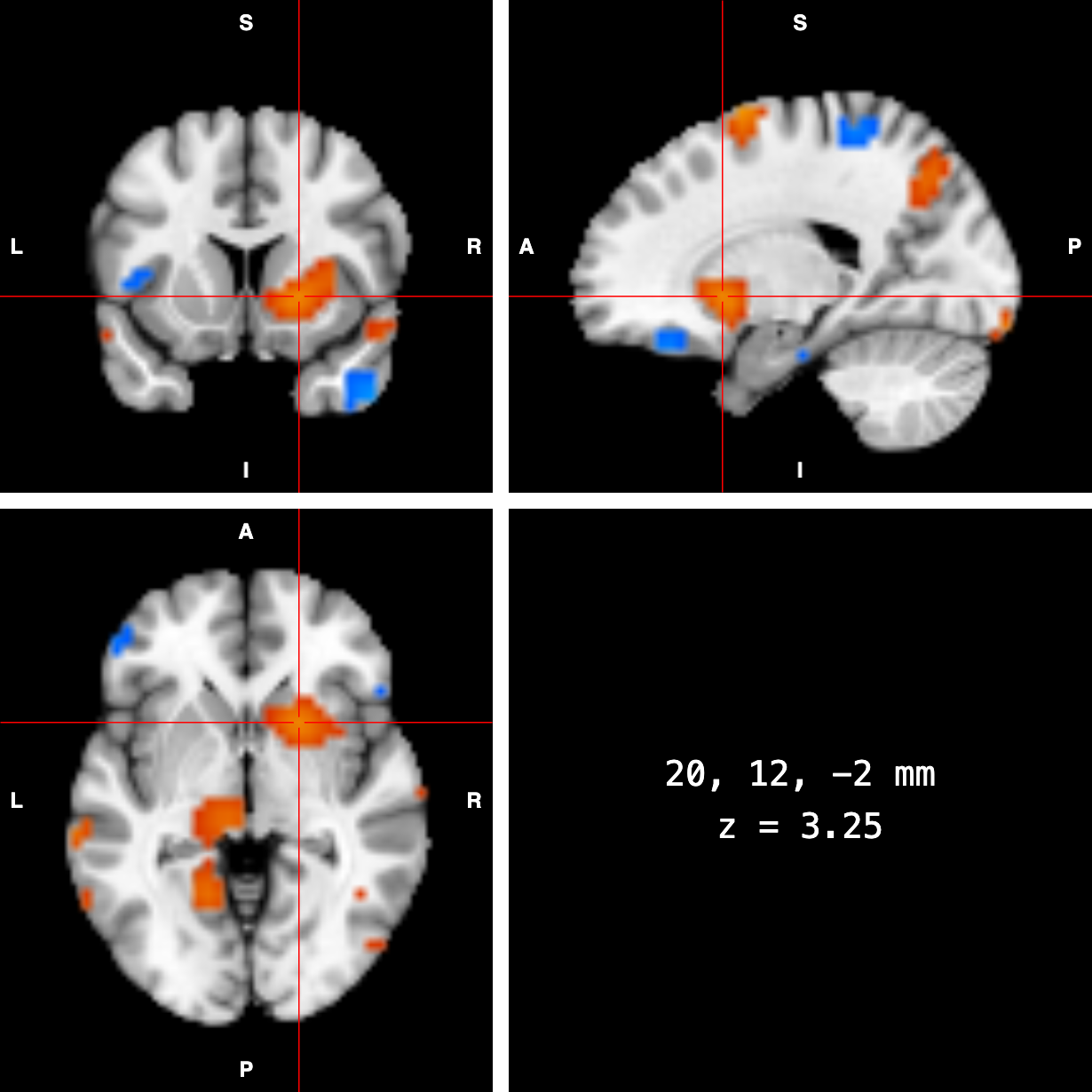 SimpleOrthogonalViewer in its 2 by 2 layout: coronal, sagittal and axial views with a red crosshair on a positive cluster in the right putamen, and a fourth cell reading 20, 12, -2 mm and z = 3.25