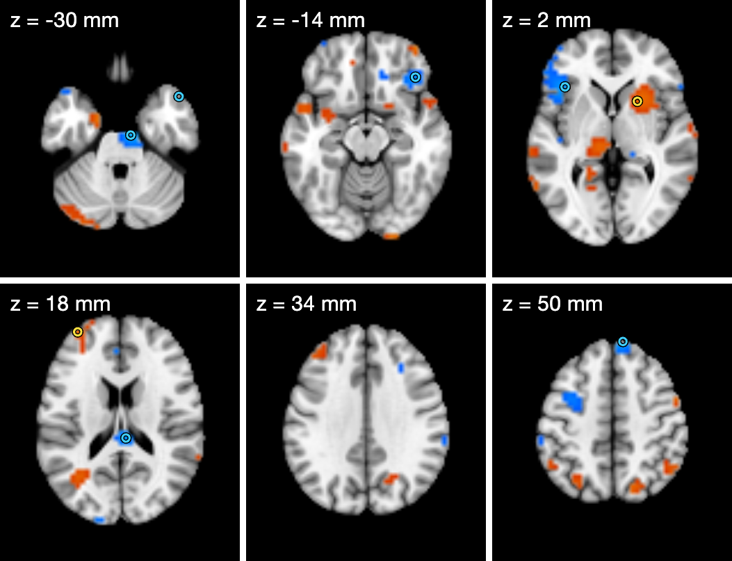 Six axial slices from z = -30 to 50 mm in a 3 by 2 grid, with ring markers on positive peaks in yellow and negative peaks in cyan