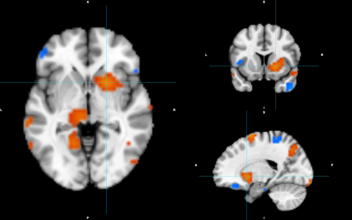 Still image of the interactive viewer: axial, coronal and sagittal views of the template with the statistic map, crosshair on a positive cluster